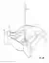 Fig. 11 - Transiliac-transsacral method of performing lumbar spinal interventions