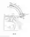 Fig. 17 - Transiliac-transsacral method of performing lumbar spinal interventions
