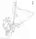 Fig. 18 - Transiliac-transsacral method of performing lumbar spinal interventions
