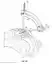 Fig. 24 - Transiliac-transsacral method of performing lumbar spinal interventions