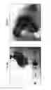Fig. 07 - IMPLANT DELIVERY DEVICE AND METHOD