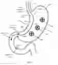Fig. 29 - Methods and Devices to Treat Obesity