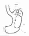 Fig. 19 - Apparatus for treating obesity