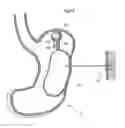 Fig. 20 - Apparatus for treating obesity