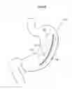 Fig. 41 - Apparatus for treating obesity