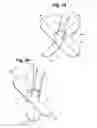 Fig. 25 - Metal vascular aperture closure device