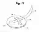 Fig. 18 - Metal vascular aperture closure device