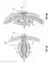 Fig. 12 - INTERSPINOUS SPACER