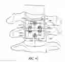 Fig. 22 - Methods and apparatuses for stabilizing the spine through an access device