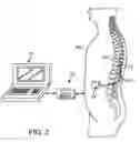 Fig. 03 - System and method for reducing excitability of dorsal root fiber by introducing stochastic background noise