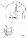 Fig. 02 - Therapy adjustment