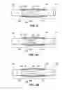 Fig. 05 - Self adjusting venous equalizing graft and endothelial lining therefor