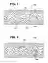 Fig. 02 - Rapamycin reservoir eluting stent