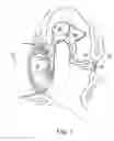 Fig. 02 - Radiopaque middle ear prosthesis