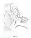 Fig. 03 - Radiopaque middle ear prosthesis