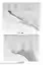 Fig. 16 - PARTIAL JOINT RESURFACING IMPLANT, INSTRUMENTATION AND METHOD
