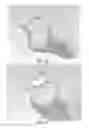 Fig. 18 - PARTIAL JOINT RESURFACING IMPLANT, INSTRUMENTATION AND METHOD