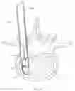 Fig. 37 - Inter-body implantation system and method