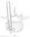 Fig. 40 - Inter-body implantation system and method