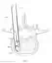 Fig. 37 - Inter-body implant