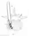 Fig. 45 - Inter-body implant