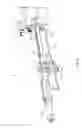 Fig. 74 - Inter-body implant
