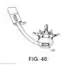 Fig. 17 - Apparatus and kit for distraction of tissue surfaces