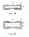 Fig. 20 - Apparatus and kit for distraction of tissue surfaces