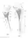 Fig. 02 - Hip stem prosthesis