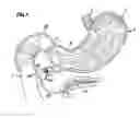 Fig. 02 - Obesity treatment and device