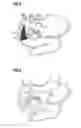 Fig. 03 - Obesity treatment and device