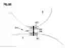 Fig. 15 - Obesity treatment and device