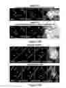 Fig. 32 - Humanized model of membrane attack complex (MAC) formation on murine retina and compositions, kits and methods for treatment of macular degeneration
