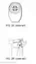 Fig. 03 - Inflatable stomal implant