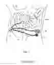 Fig. 08 - Inflatable stomal implant