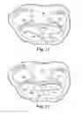 Fig. 09 - Articles, devices, and methods for pelvic surgery