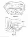 Fig. 10 - Articles, devices, and methods for pelvic surgery
