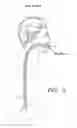 Fig. 04 - METHODS AND APPARATUS FOR TREATMENT OF OBESITY