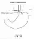 Fig. 06 - METHODS AND APPARATUS FOR TREATMENT OF OBESITY
