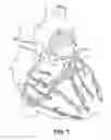 Fig. 02 - Isolating cardiac circulation