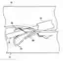 Fig. 01 - Device and method for establishing an artificial arterio-venous fistula