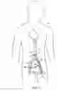 Fig. 02 - Device and method for establishing an artificial arterio-venous fistula