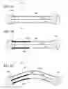 Fig. 09 - Stent graft