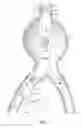 Fig. 02 - Stent-graft with adjustable length