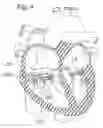 Fig. 06 - DEVICE AND METHOD FOR RESHAPING MITRAL VALVE ANNULUS