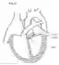 Fig. 08 - DEVICE AND METHOD FOR RESHAPING MITRAL VALVE ANNULUS