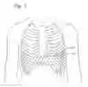 Fig. 02 - Transapical delivery system for heart valves