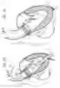 Fig. 06 - Transapical delivery system for heart valves