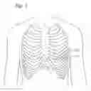 Fig. 02 - Transapical delivery system for heart valves