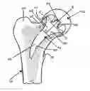Fig. 01 - Hip joint prosthesis